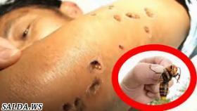 10 смертельно опасных укусов насекомых