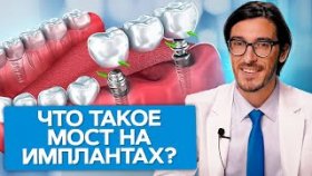 Что такое мост на имплантах? Что такое мост на имплантах и как сэкономить на имплантации зубов?