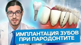 Имплантация зубов при пародонтите. Можно ли проводить имплантацию зубов при пародонтите?