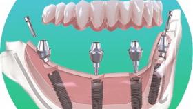 Методика имплантации зубов All-on-4