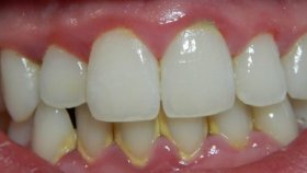 Зубной камень: причины появления, виды и последствия несвоевременного удаления. Можно ли избавиться от проблемы дома?