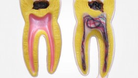 Как стоматологи определяют наличие кариеса?