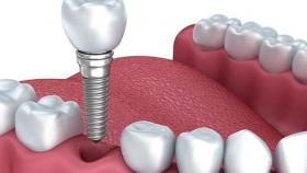 Имплантация зубов: действительно ли больно и дорого?