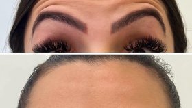Ботокс (Ботулинотерапия) Лицо (Full Face)