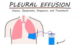 Pleural Effusion Explained: Causes, Symptoms, and Treatment