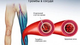 Причины тромбоза о которых вы не знали