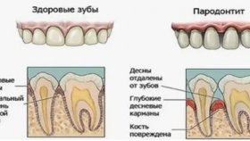 Основные симптомы пародонтита
