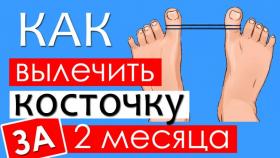 Как избавиться от вальгусной косточки без операции