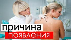 Почему появляются родинки на теле? Это важно знать!