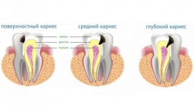 Принципы лечения кариеса в специализированной клинике