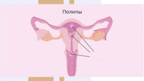 Полип в матке: почему важно его контролировать и лечить?