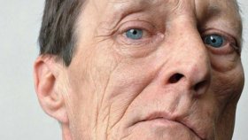 Микроинсульт: симптомы, диагностика, лечение