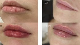 Почему у девушек популярно увеличение губ