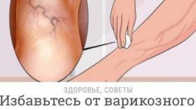 Как я избавилась от варикоза за 1 курс